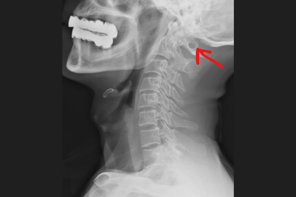 Arcuate Foramen