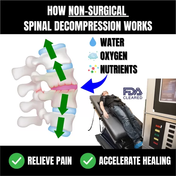Non-Surgical Spinal Decompression Work